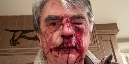 Rudi Van Decraen nach dem Angriff. Multiple Verletztungen trug der Jäger bei dem Angriff davon, die im Krankenhaus behandelt werden mussten.